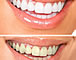 COSMETIC DENTISTRY / ZÄHNEBLEICHEN Cosmetic dentistry - Zähnebleichen